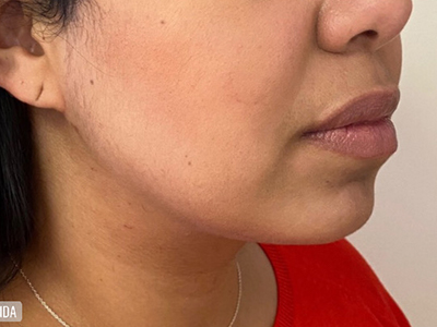 Buccal Fat Removal
