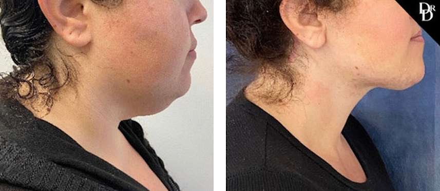 Before and After Neck Lift 1
