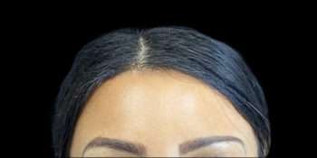 Hairline Lowering