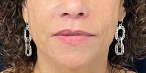 Lip Lift after photo by Dr. Demetri in Beverly Hills, CA