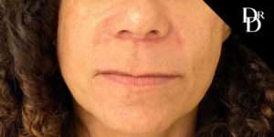 Lip Lift before photo by Dr. Demetri in Beverly Hills, CA