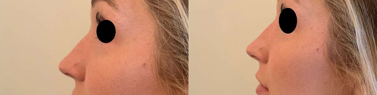 Liquid Rhinoplasty Before & After Results