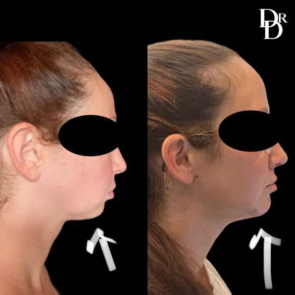 Chin Augmentation before and after photos by Dr. Demetri Arnaoutakis in Tampa, FL