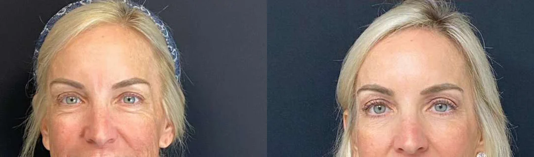 Eyelid Surgery before and after photos by Dr. Demetri Arnaoutakis in Tampa, FL
