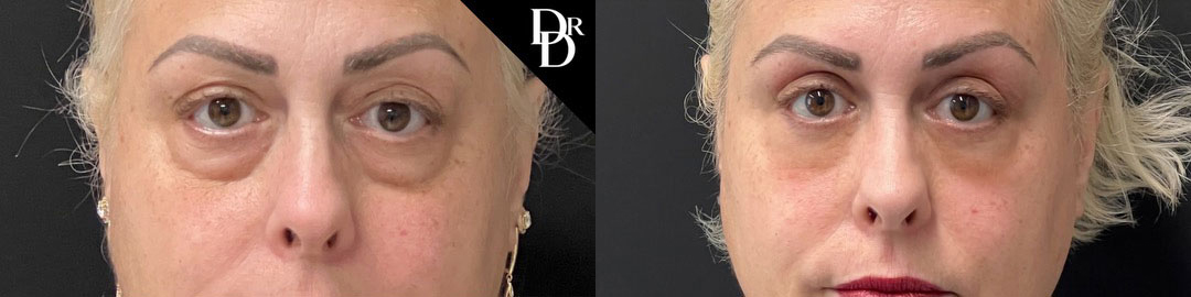 Eyelid Surgery before and after photos by Dr. Demetri Arnaoutakis in Tampa, FL