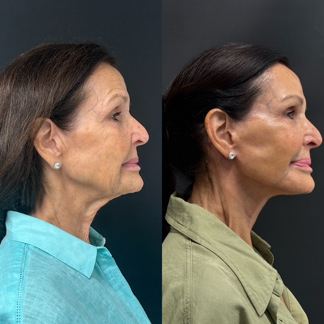 Facelift Before And After Photos By Dr. Demetri Arnaoutakis In Tampa, Fl