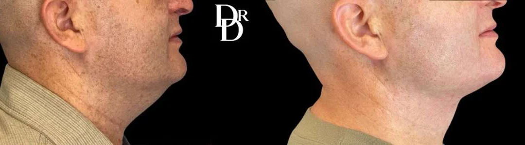 Facetite Before And After Photos By Dr. Demetri Arnaoutakis In Tampa, Fl