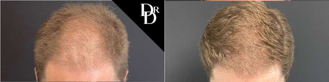 Hair Transplant Before And After Photos By Dr. Demetri Arnaoutakis In Tampa, Fl