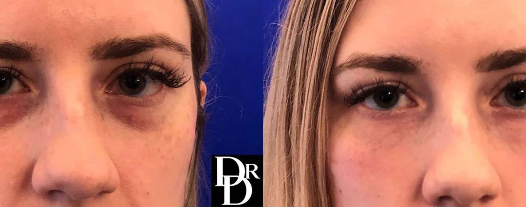 Injectable/Dermal Fillers Before And After Photos By Dr. Demetri Arnaoutakis In Tampa, Fl