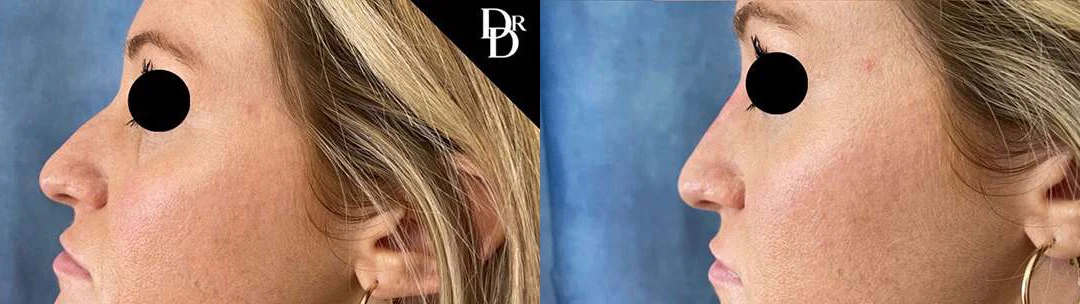 Liquid Rhinoplasty before and after photos by Dr. Demetri Arnaoutakis in Tampa, FL
