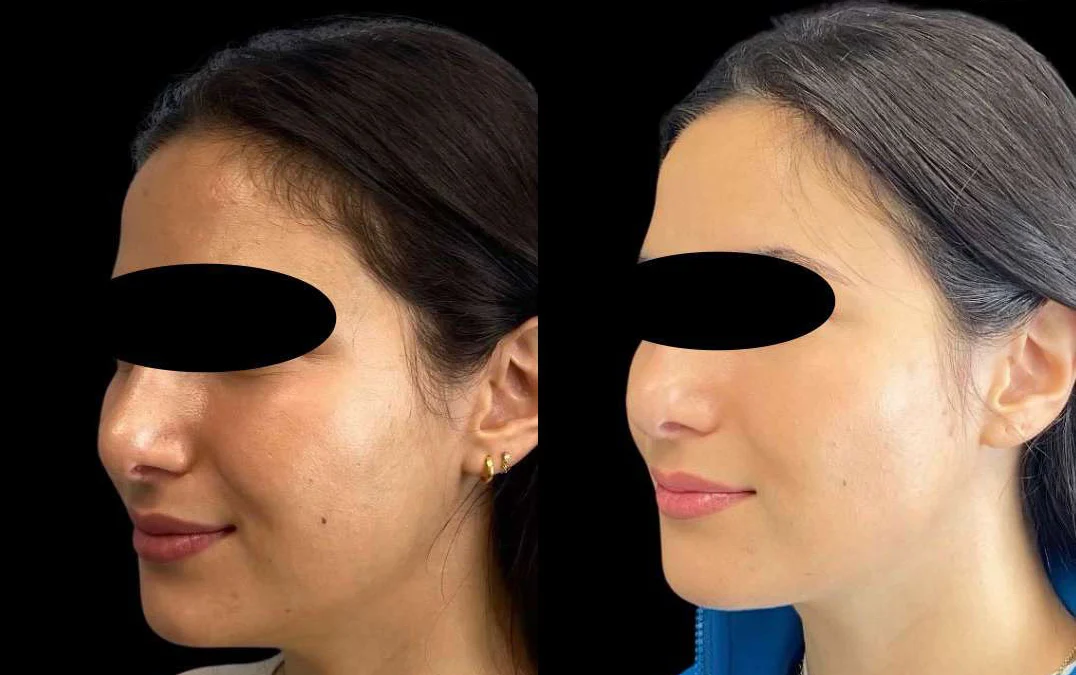 Morpheus8 Before And After Photos By Dr. Demetri Arnaoutakis In Tampa, Fl
