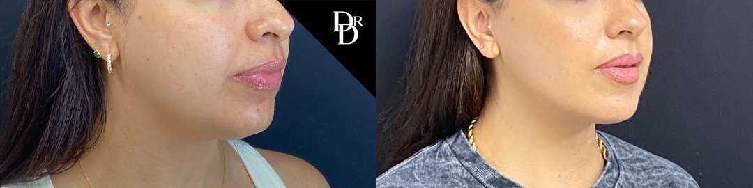 Neck Lift Before And After Photos By Dr. Demetri Arnaoutakis In Tampa, Fl