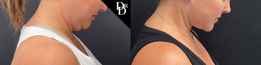 Neck Lift before and after photos by Dr. Demetri Arnaoutakis in Tampa, FL