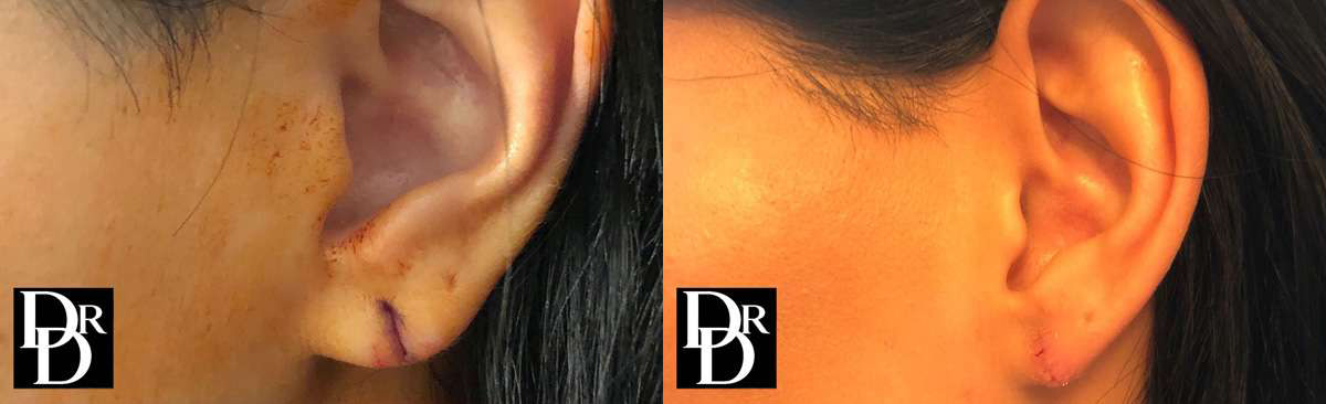Earlobe Repair Before And After Photos By Dr. Demetri Arnaoutakis In Tampa, Fl
