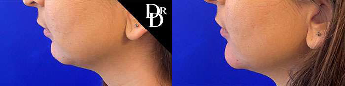 Chin Augmentation before and after photos by Dr. Demetri Arnaoutakis in Tampa, FL