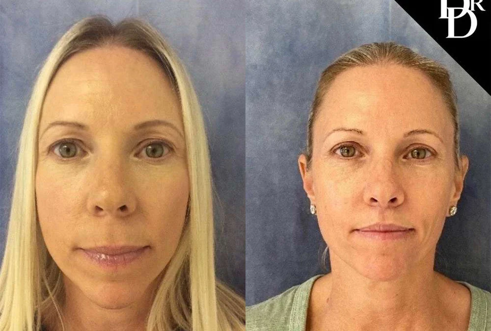 Eyelid Surgery before and after photos by Dr. Demetri Arnaoutakis in Tampa, FL