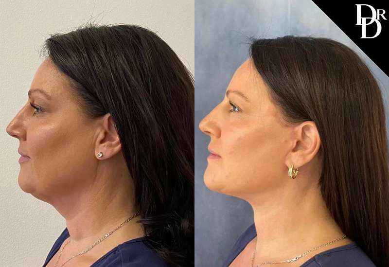 Facelift Before And After Photos By Dr. Demetri Arnaoutakis In Tampa, Fl