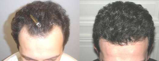 Hair Transplant Before And After Photos By Dr. Demetri Arnaoutakis In Tampa, Fl