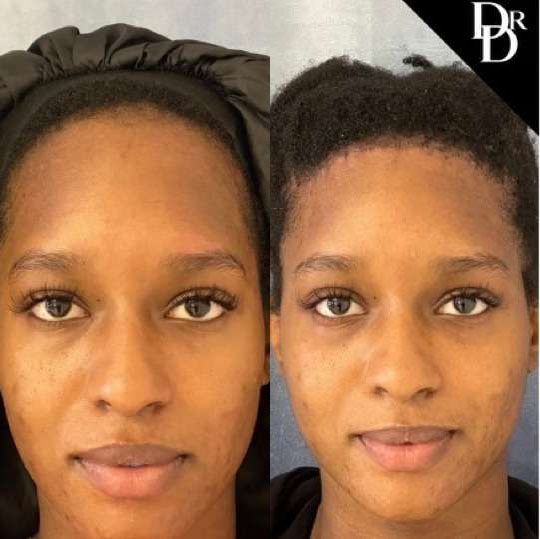 Hairline Lowering Surgery Before And After Photos By Dr. Demetri Arnaoutakis In Tampa, Fl