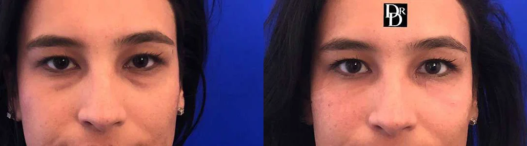 Injectable/Dermal Fillers Before And After Photos By Dr. Demetri Arnaoutakis In Tampa, Fl