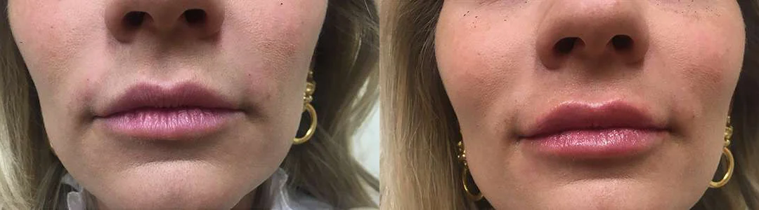 Injectable/Dermal Fillers Before And After Photos By Dr. Demetri Arnaoutakis In Tampa, Fl