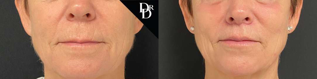 Lip Lift before and after photos by Dr. Demetri Arnaoutakis in Tampa, FL