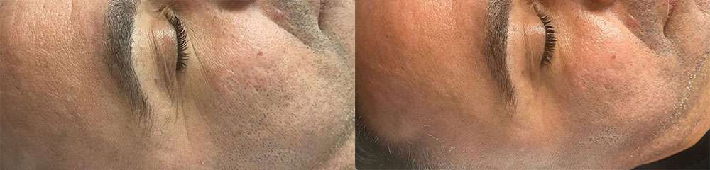 Microneedling Before And After Photos By Dr. Demetri Arnaoutakis In Tampa, Fl