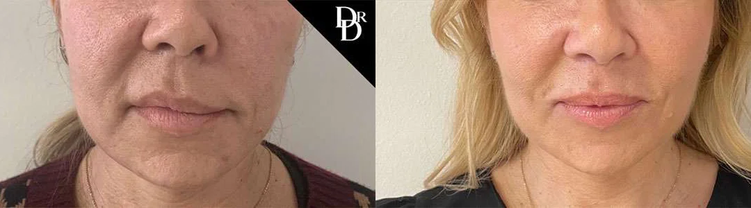 Morpheus8 Before And After Photos By Dr. Demetri Arnaoutakis In Tampa, Fl