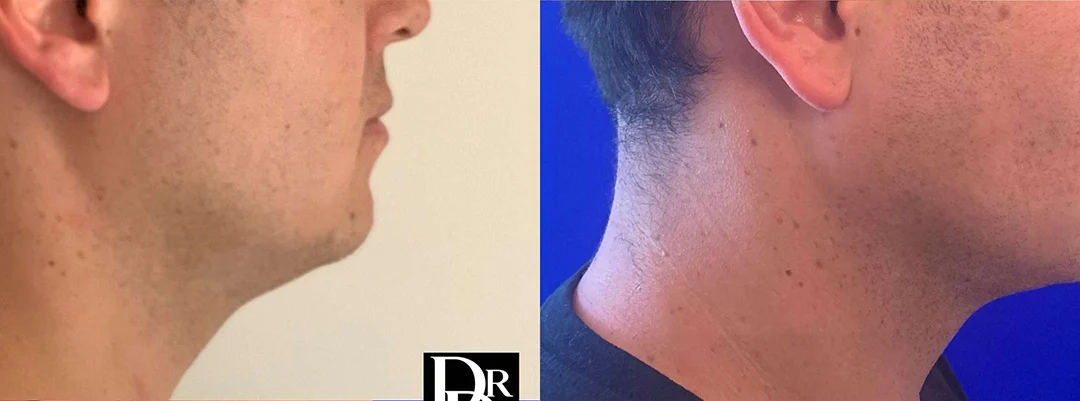 Neck Lift Before And After Photos By Dr. Demetri Arnaoutakis In Tampa, Fl