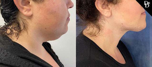 Neck Lift before and after photos by Dr. Demetri Arnaoutakis in Tampa, FL