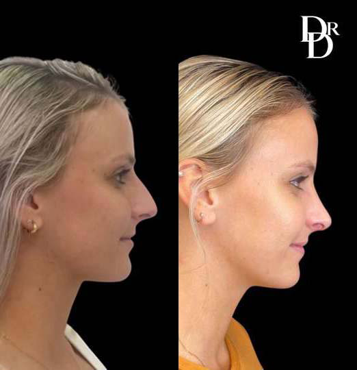 Rhinoplasty before and after photos by Dr. Demetri Arnaoutakis in Tampa, FL