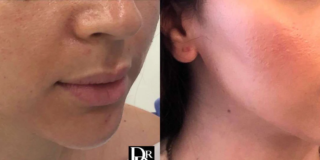 Buccal Fat Pad Removal before and after photos by Dr. Demetri Arnaoutakis in Tampa, FL