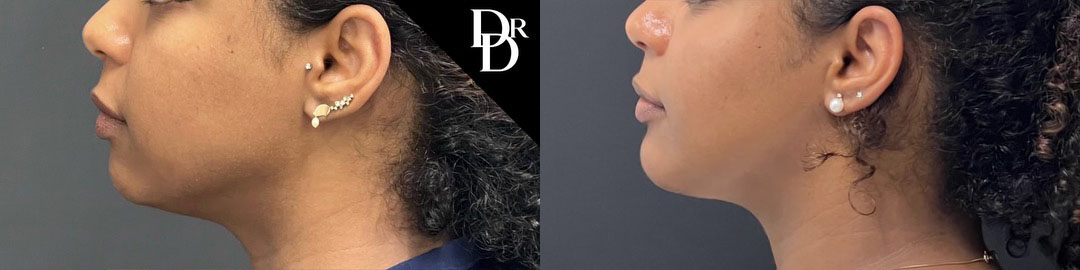 Chin Augmentation before and after photos by Dr. Demetri Arnaoutakis in Tampa, FL