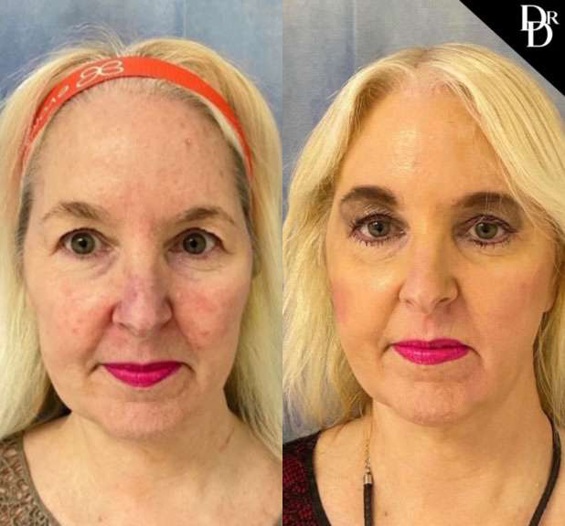 Eyelid Surgery before and after photos by Dr. Demetri Arnaoutakis in Tampa, FL