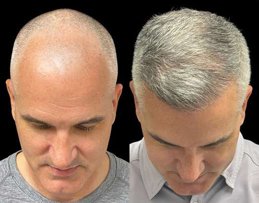 Hair Transplant Before And After Photos By Dr. Demetri Arnaoutakis In Tampa, Fl