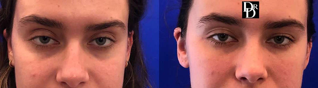 Injectable/Dermal Fillers Before And After Photos By Dr. Demetri Arnaoutakis In Tampa, Fl