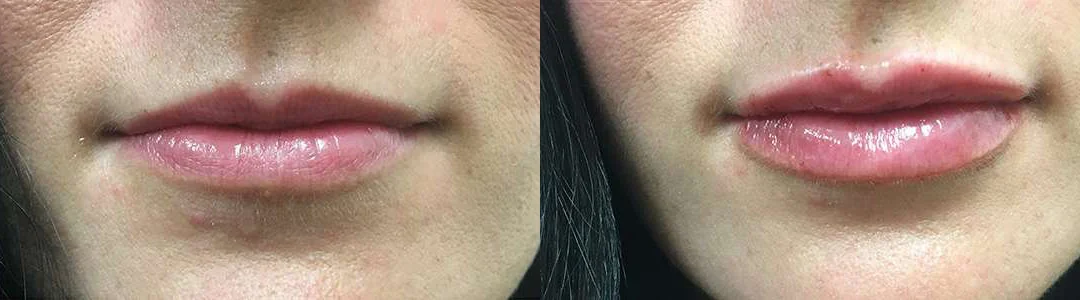Injectable/Dermal Fillers Before And After Photos By Dr. Demetri Arnaoutakis In Tampa, Fl