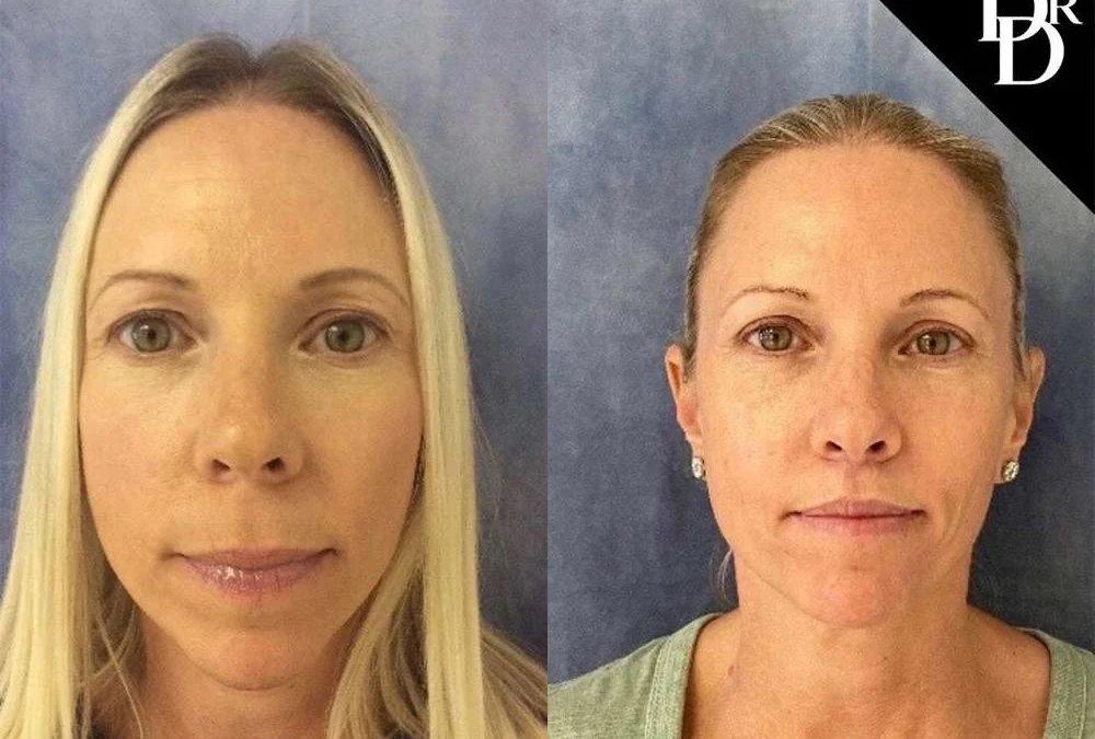Lip Lift before and after photos by Dr. Demetri Arnaoutakis in Tampa, FL