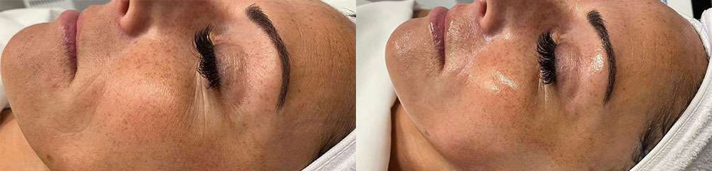 Microneedling Before And After Photos By Dr. Demetri Arnaoutakis In Tampa, Fl