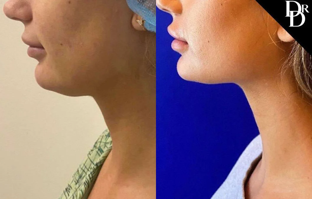 Morpheus8 Before And After Photos By Dr. Demetri Arnaoutakis In Tampa, Fl