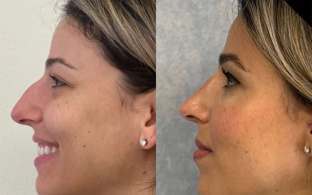 Rhinoplasty before and after photos by Dr. Demetri Arnaoutakis in Tampa, FL