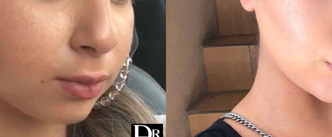 Buccal Fat Pad Removal before and after photos by Dr. Demetri Arnaoutakis in Tampa, FL