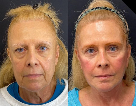 Facelift Before And After Photos By Dr. Demetri Arnaoutakis In Tampa, Fl