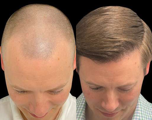 Hair Transplant Before And After Photos By Dr. Demetri Arnaoutakis In Tampa, Fl