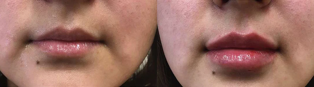 Injectable/Dermal Fillers Before And After Photos By Dr. Demetri Arnaoutakis In Tampa, Fl