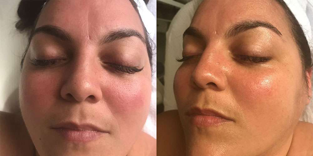 Microneedling Before And After Photos By Dr. Demetri Arnaoutakis In Tampa, Fl