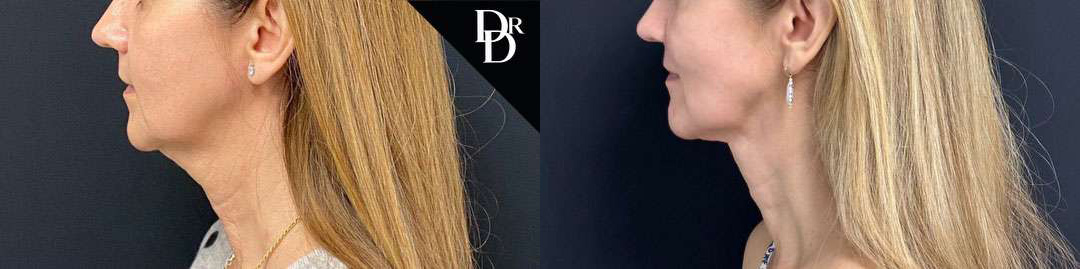 Morpheus8 Before And After Photos By Dr. Demetri Arnaoutakis In Tampa, Fl
