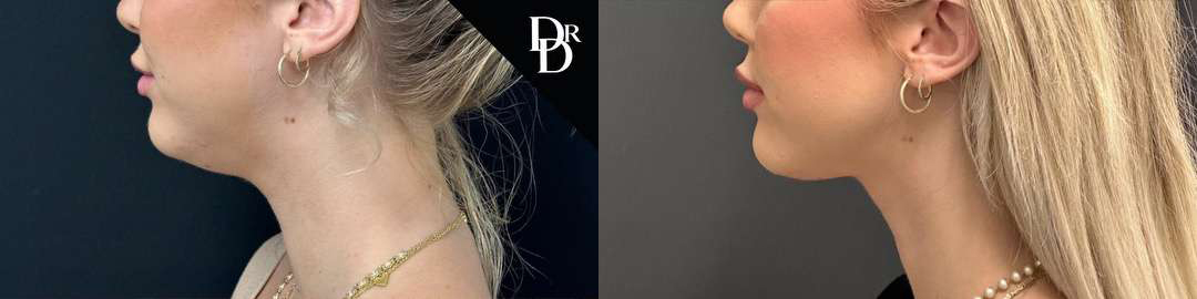 Neck Lift Before And After Photos By Dr. Demetri Arnaoutakis In Tampa, Fl