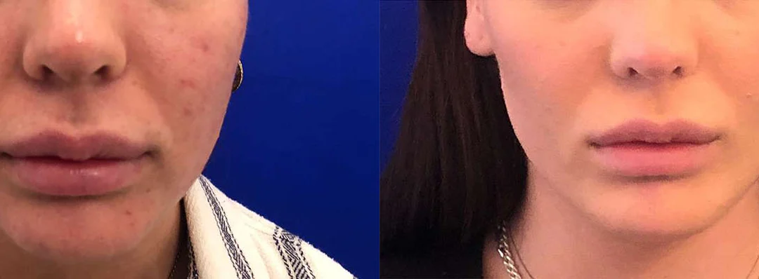 Buccal Fat Pad Removal before and after photos by Dr. Demetri Arnaoutakis in Tampa, FL