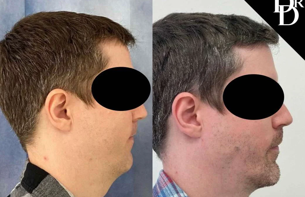 Chin Augmentation before and after photos by Dr. Demetri Arnaoutakis in Tampa, FL